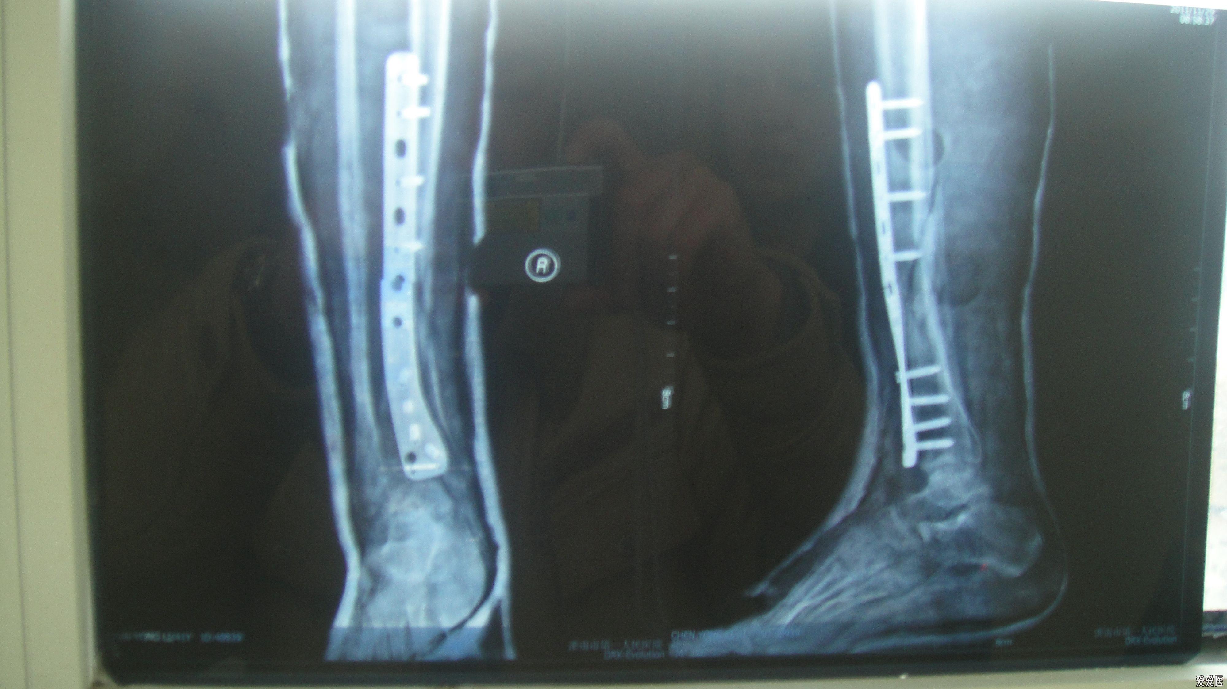 右小腿中下三分之一处胫腓骨粉碎性骨折术后160天内置钢板断了怎么办