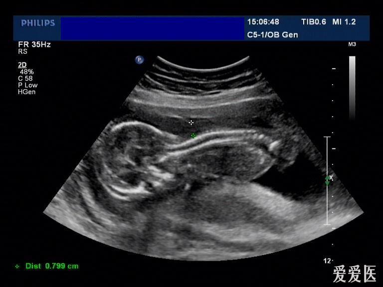 胎儿头颈部水囊瘤并胸腔积液