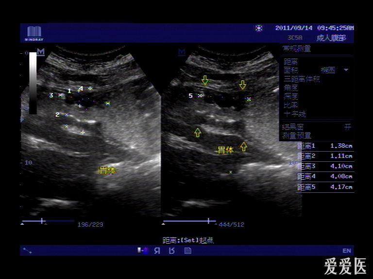 典型胃肠超声病例----------十五 胃体部恶性肿瘤(已手术)