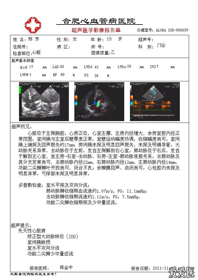 矫正大动脉转位图片