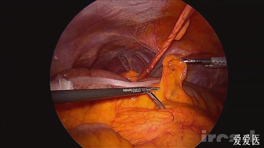 高清websurg完全性腹腔镜右半结肠腺癌切除术