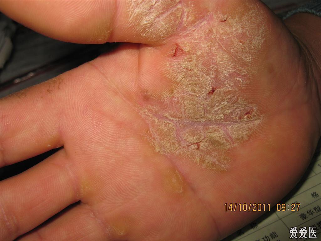 角化湿疹的症状图片图片