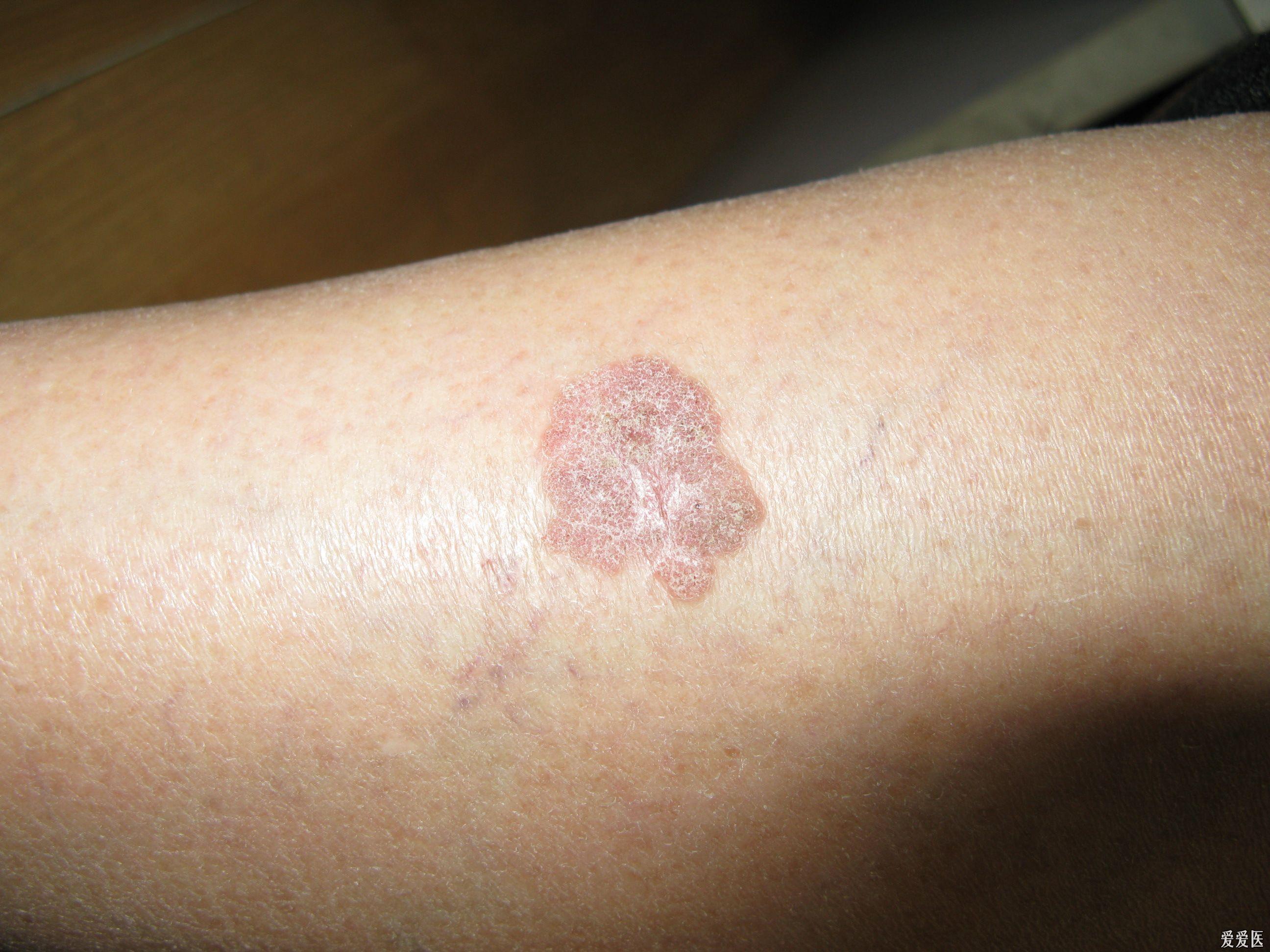 皮肤病鲍文病3张