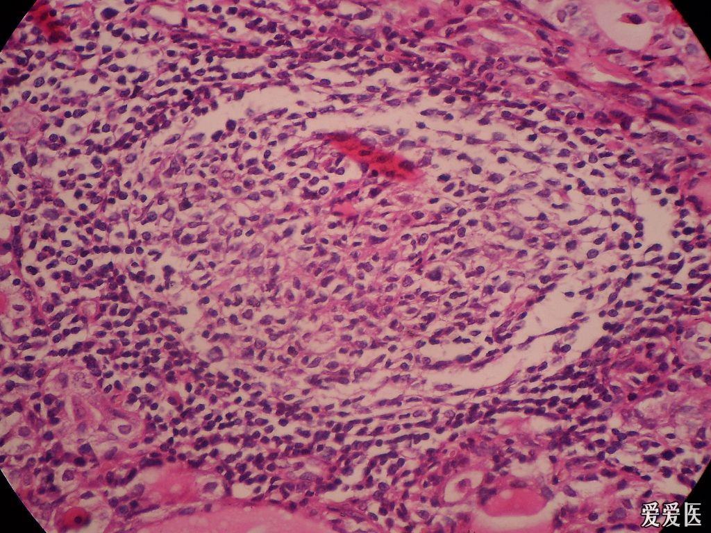 甲状腺腺瘤切片图片