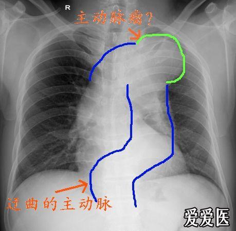 主动脉迂曲x线图片图片