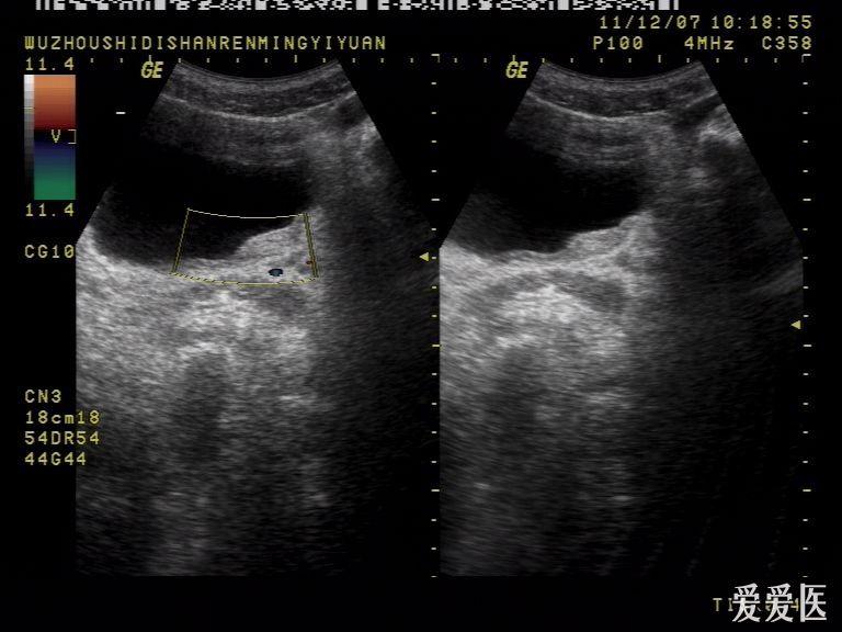膀胱囊肿超声图片图片