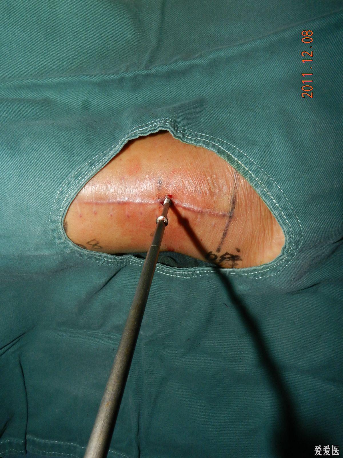 取大腿髓内钉过程图片图片