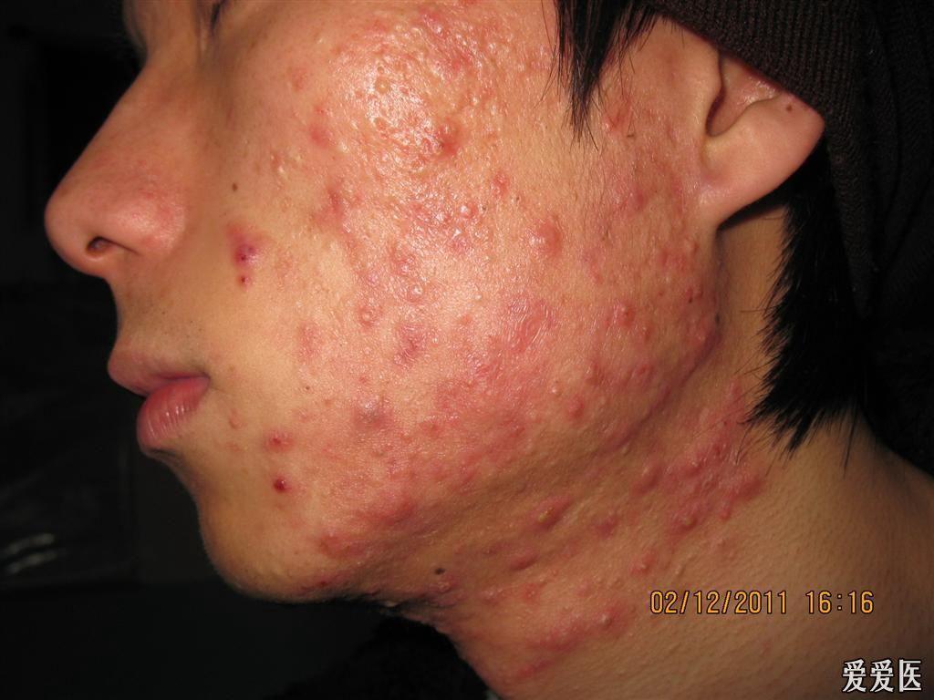 重度痤疮重度痤疮
