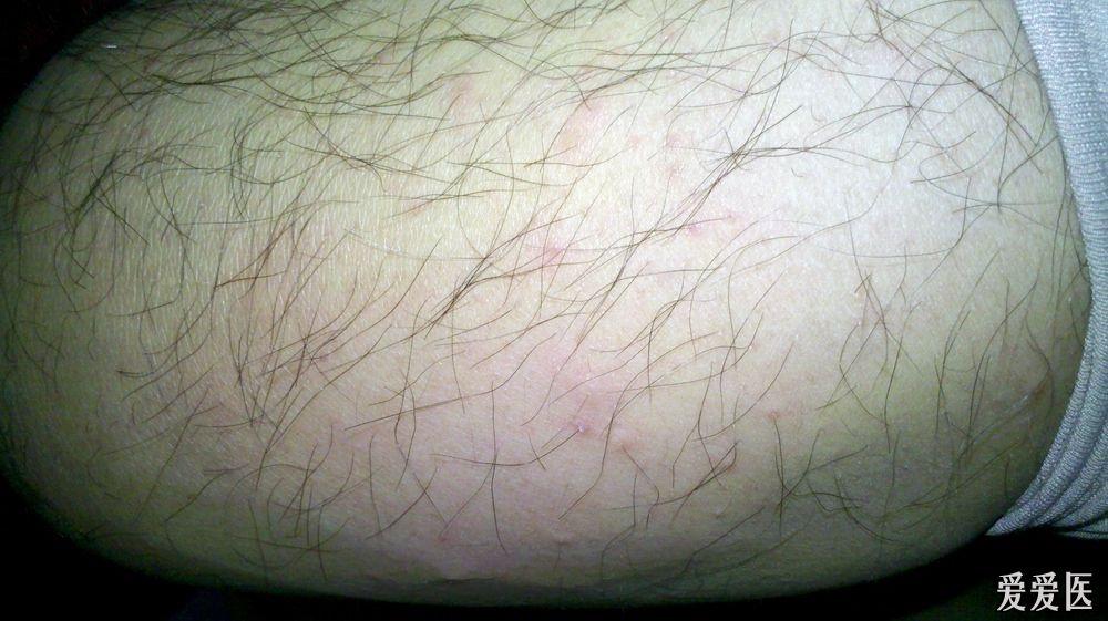 天气冷了大腿很痒腿上有红点是怎么回事啊