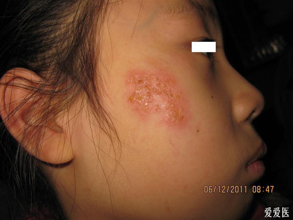 病毒疱疹图片初期症状图片