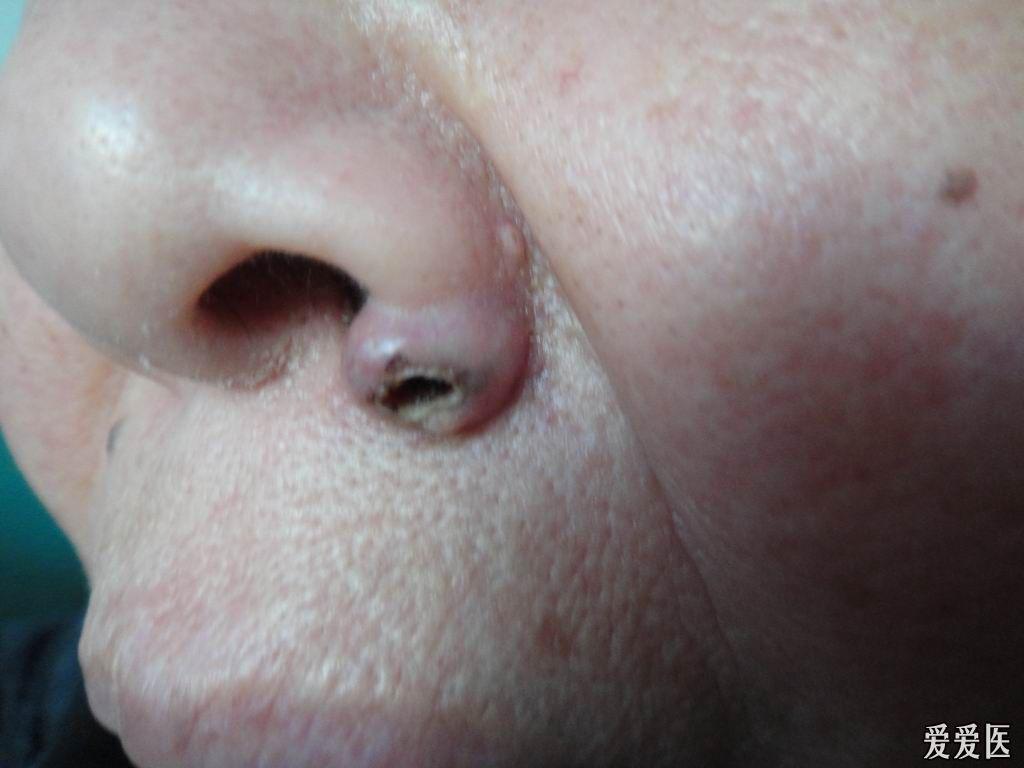 看图诊断60……角化棘皮瘤 - 皮肤及性传播疾病讨论版 - 爱爱医医学