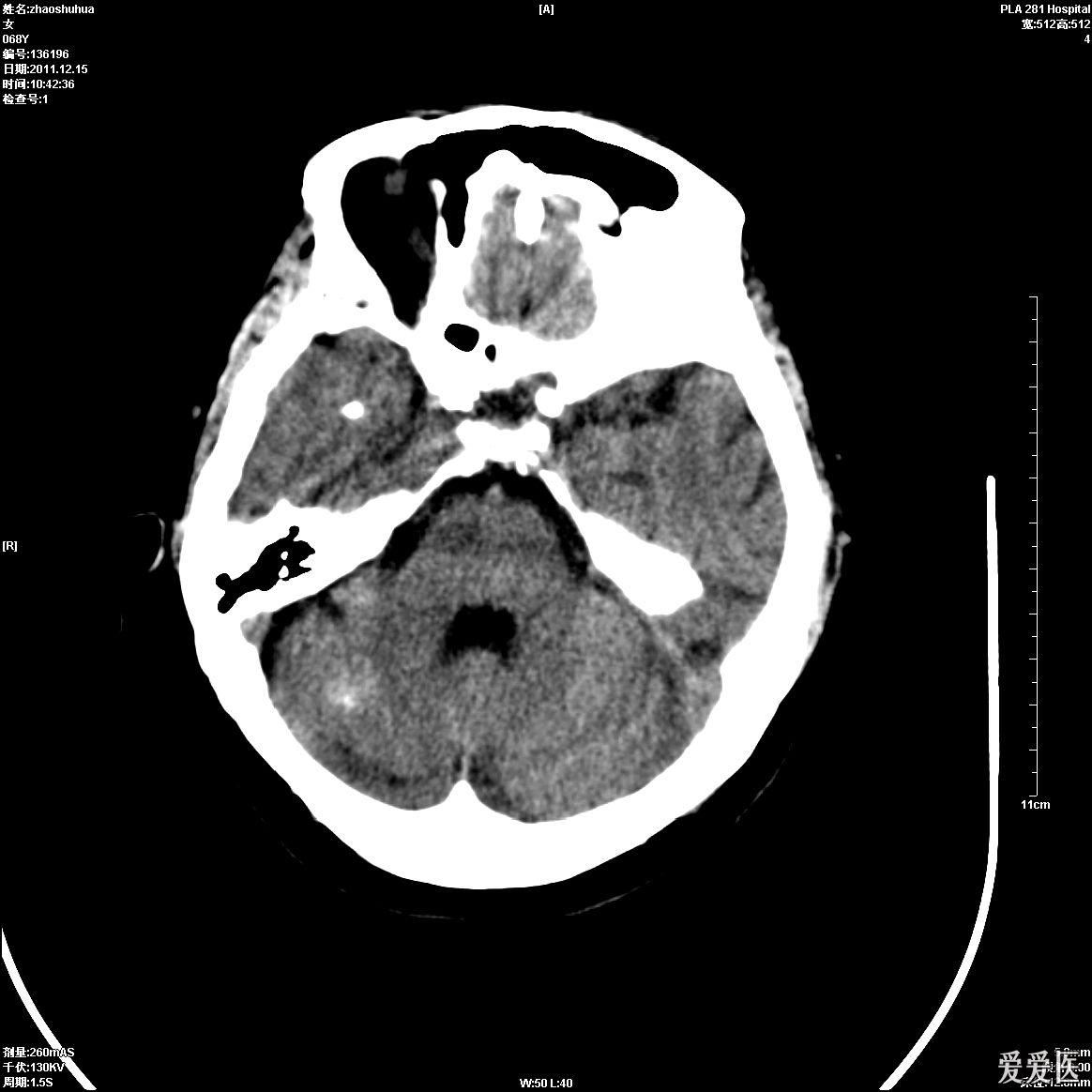 头颅CT 脑肿瘤