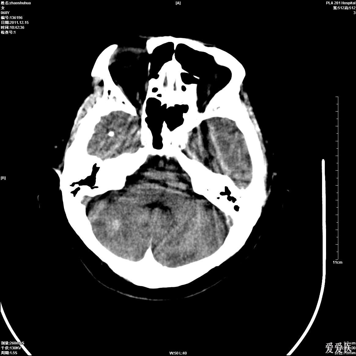 頭顱ct:腦腫瘤? - 醫學影像學討論版 - 愛愛醫醫學論壇