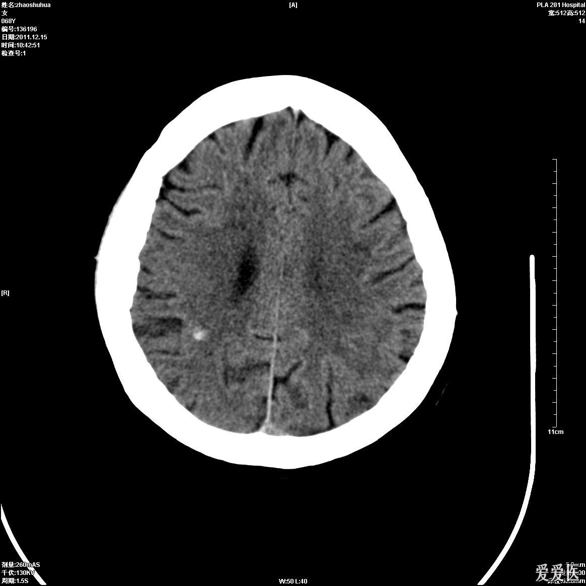 头颅ct脑肿瘤