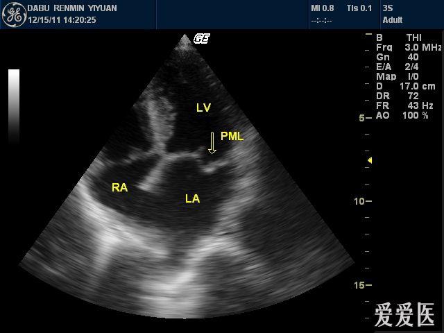 二尖瓣脱垂超声图像图片