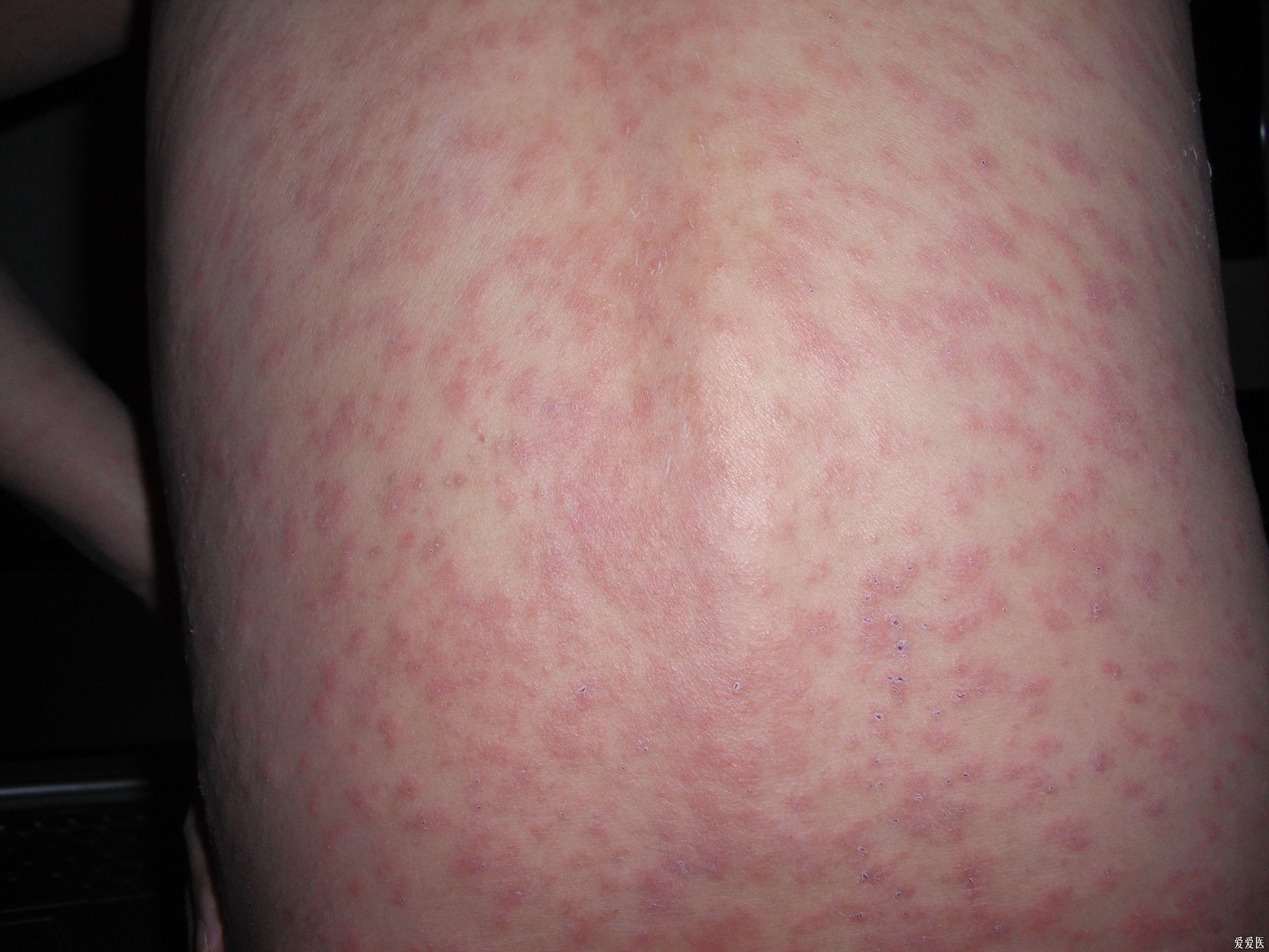 皮肤湿毒症状图片图片