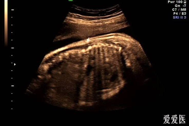 胎儿蝴蝶椎超声图片图片