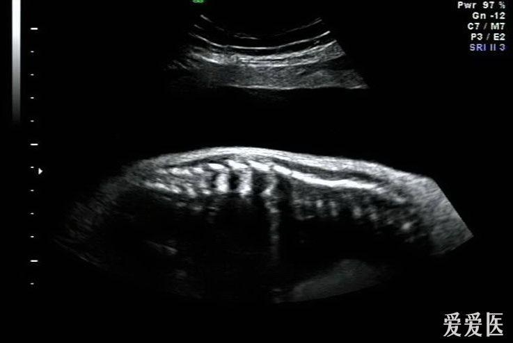 胎儿半椎体图片