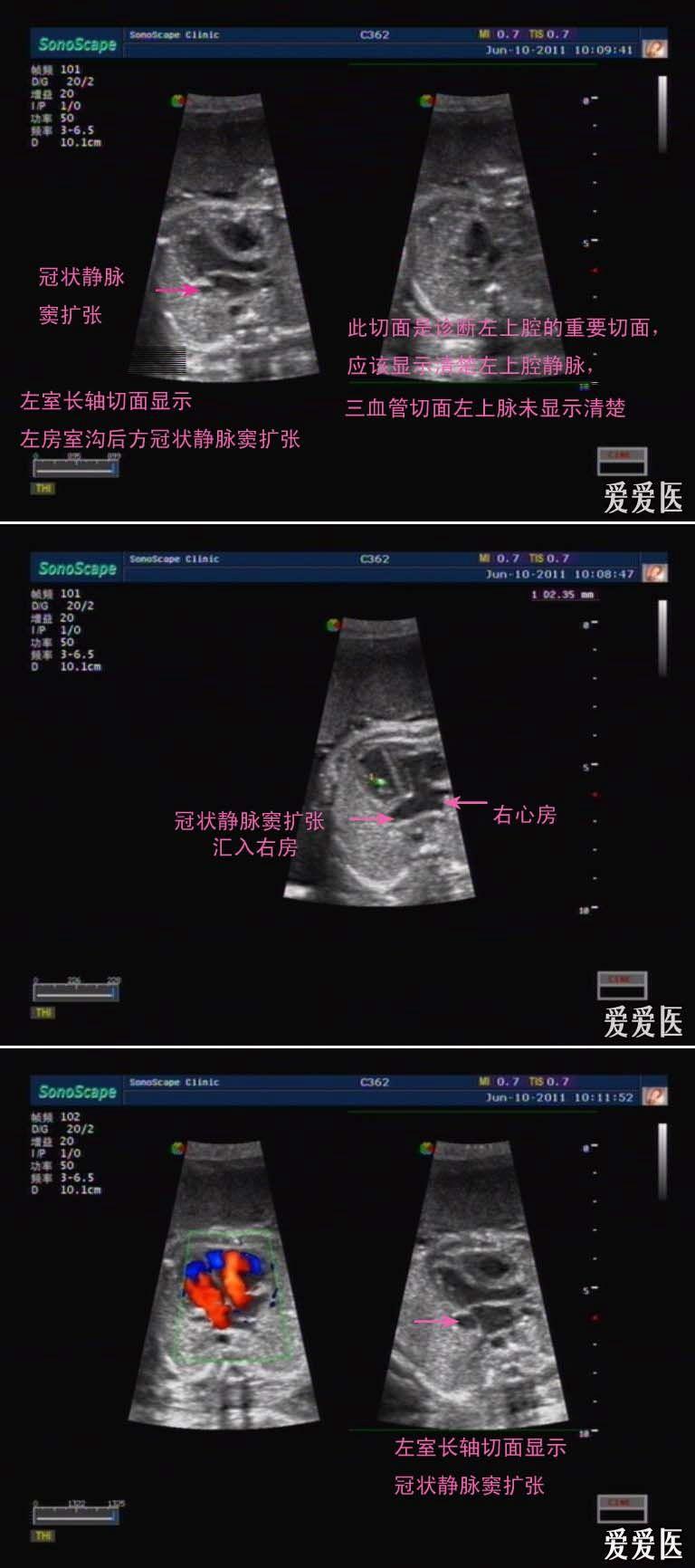 一例胎儿彩超,心脏看了就是觉得不舒服.