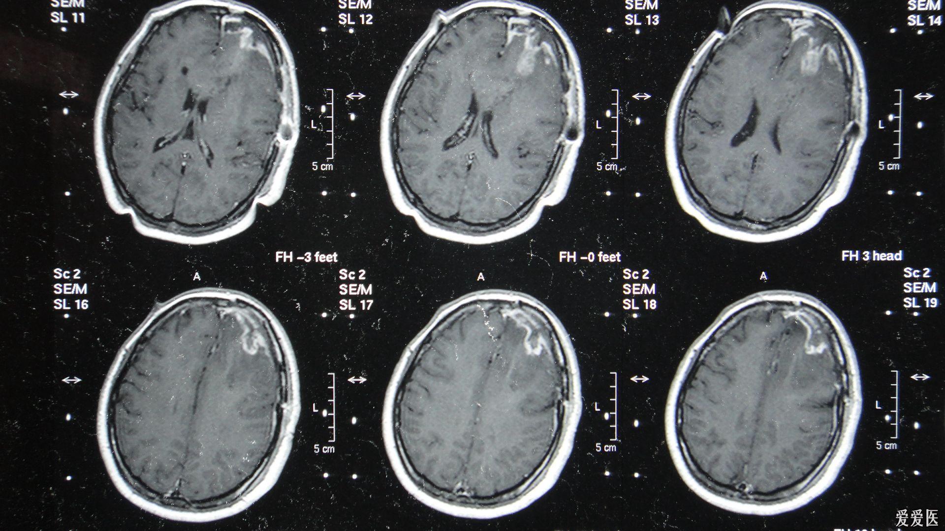 左額葉膠質瘤手術後6年右額葉病灶膠質瘤轉移