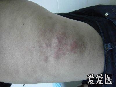 双侧股外侧及膝部红斑寒冷性脂膜炎