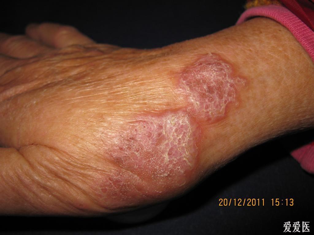 皮肤病看图识病扁平苔藓