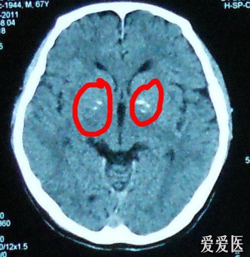 CT检查脑部有钙化点是什么意思？