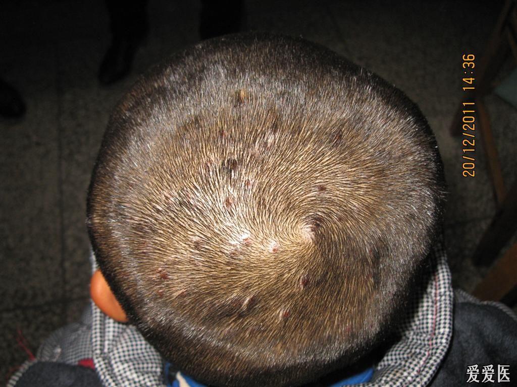 典型头部点滴状银屑病伴束状发