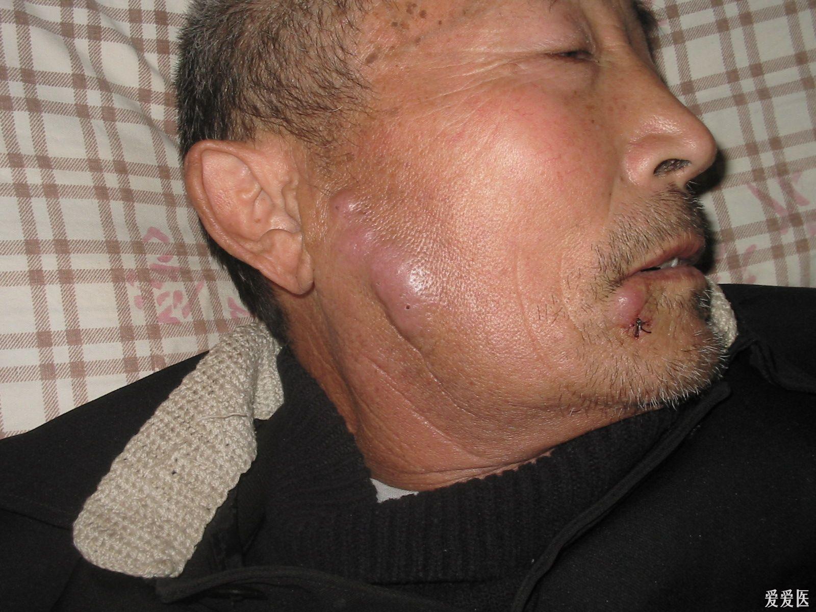 有面部丘疹斑块结节瘙痒2年余伴周身丘疹半年