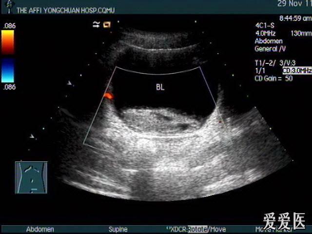 右肾挫伤,膀胱血凝块——zengerya - 超声医学讨论版 - 爱爱医医学