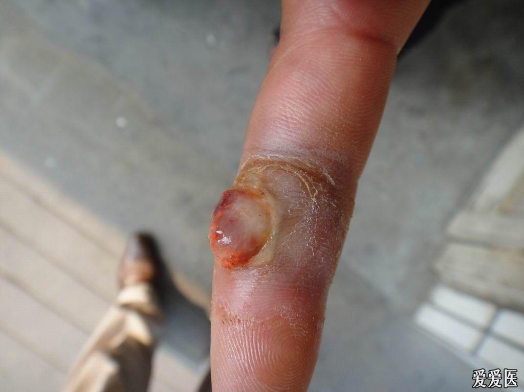 两例化脓性肉芽肿