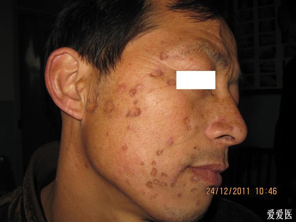 无可争议的典型病例--------汗孔角化