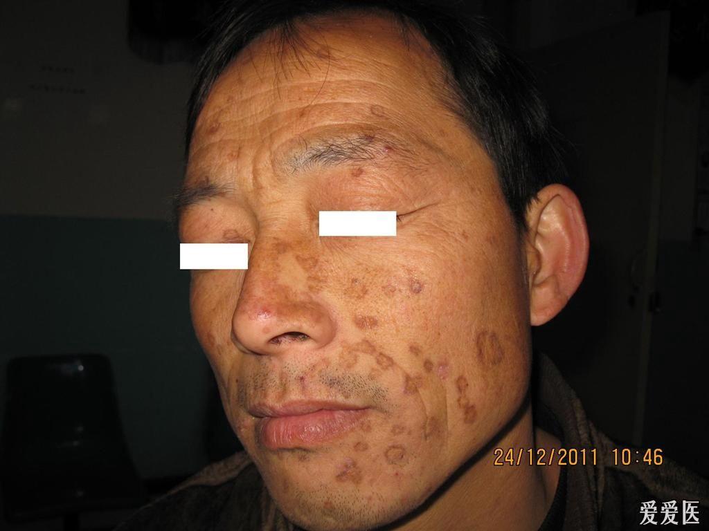 无可争议的典型病例--------汗孔角化