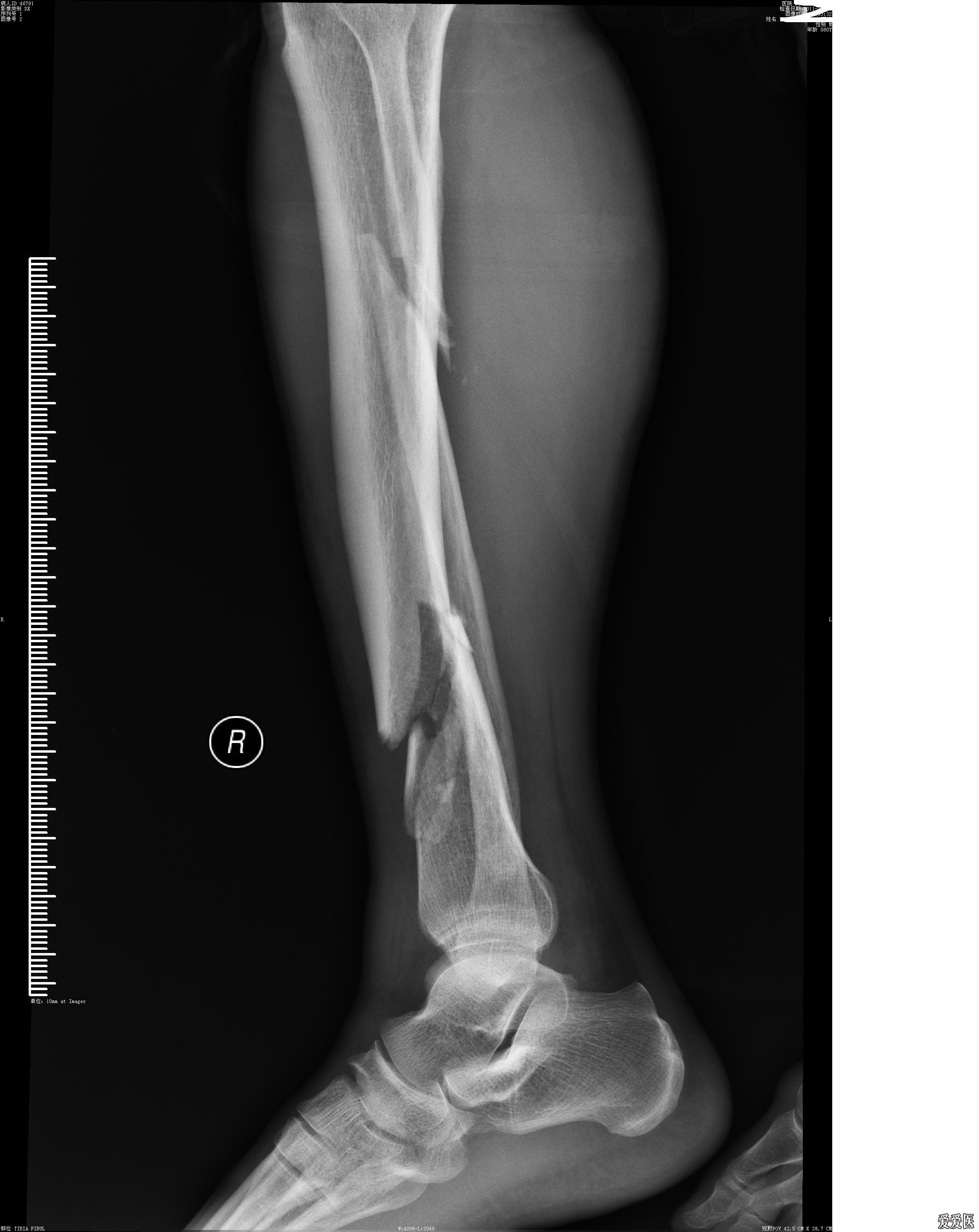 左胫骨下端骨折图片