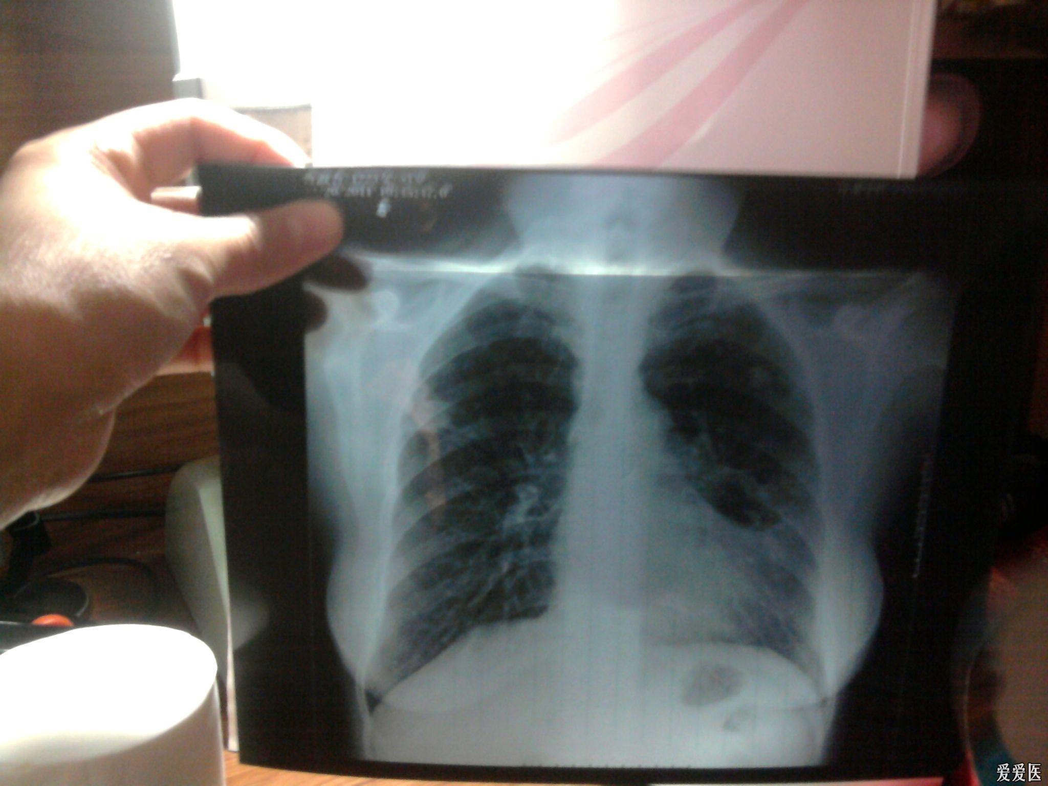 肺结核患者 胸片复查后请老师帮看看