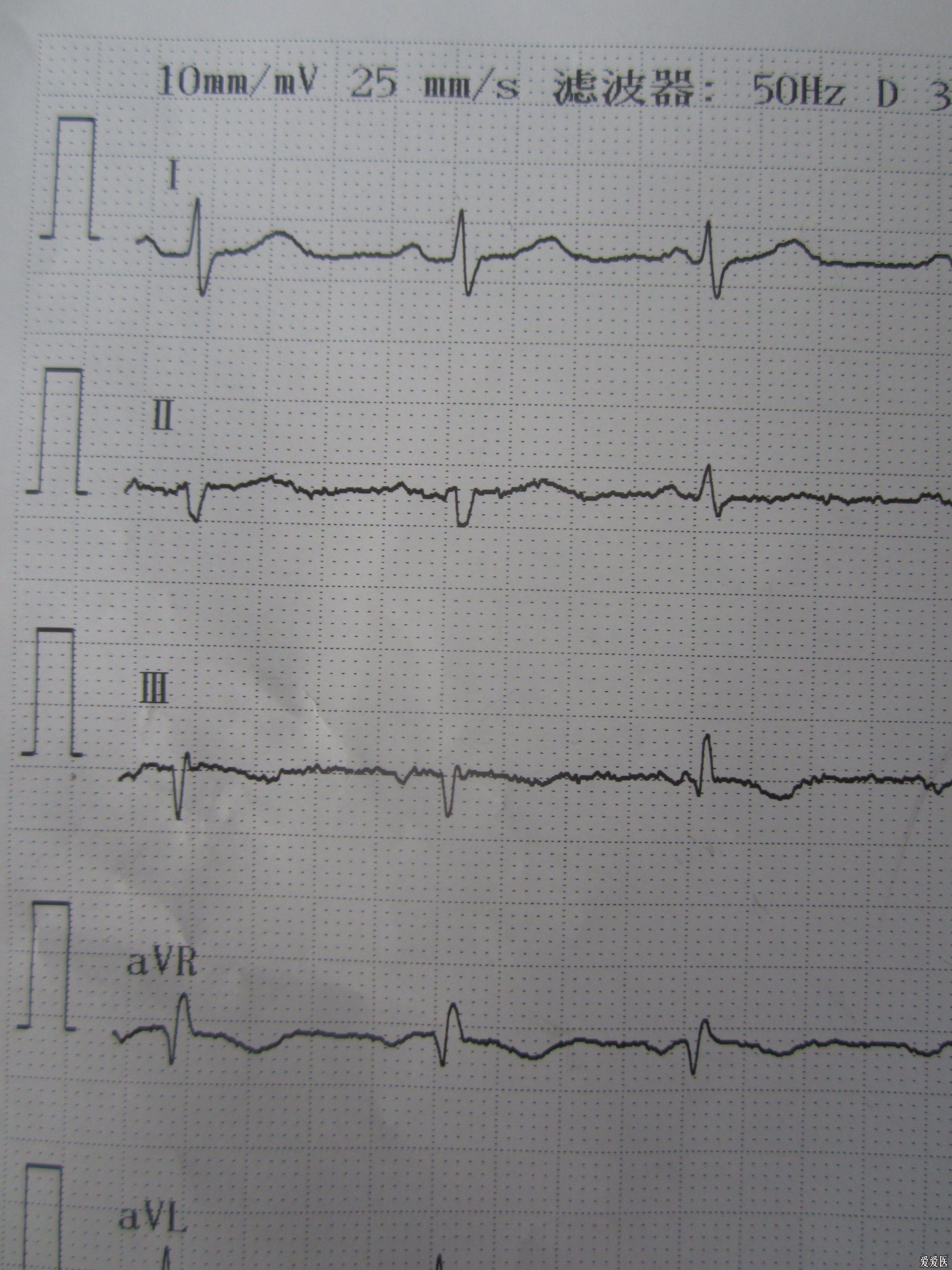 请高手分析心电图