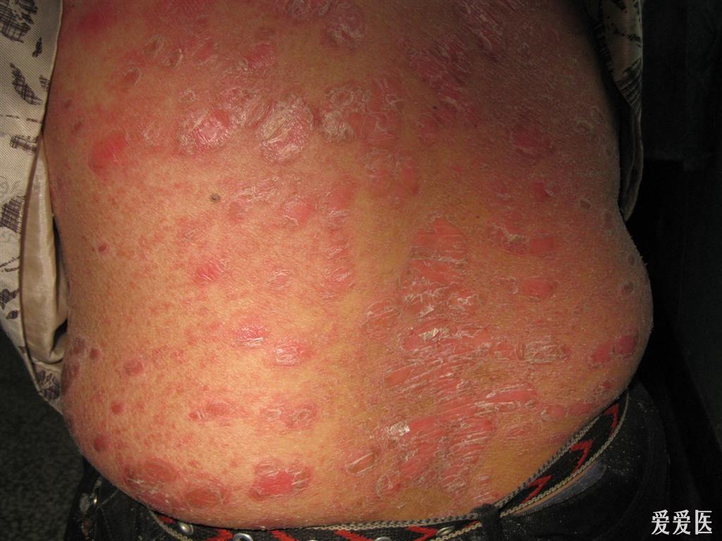 典型病例银屑病2