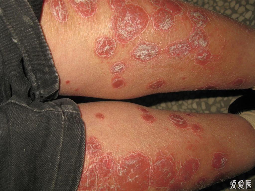 典型病例银屑病2