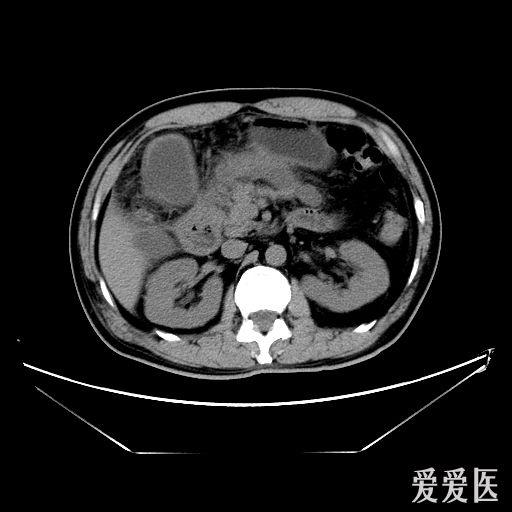 墨菲氏征阳性