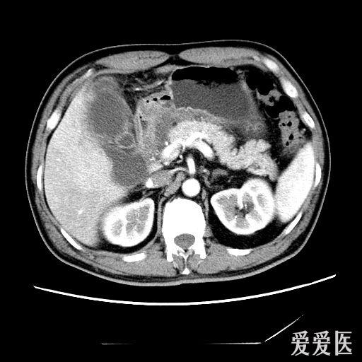 墨菲氏征阳性