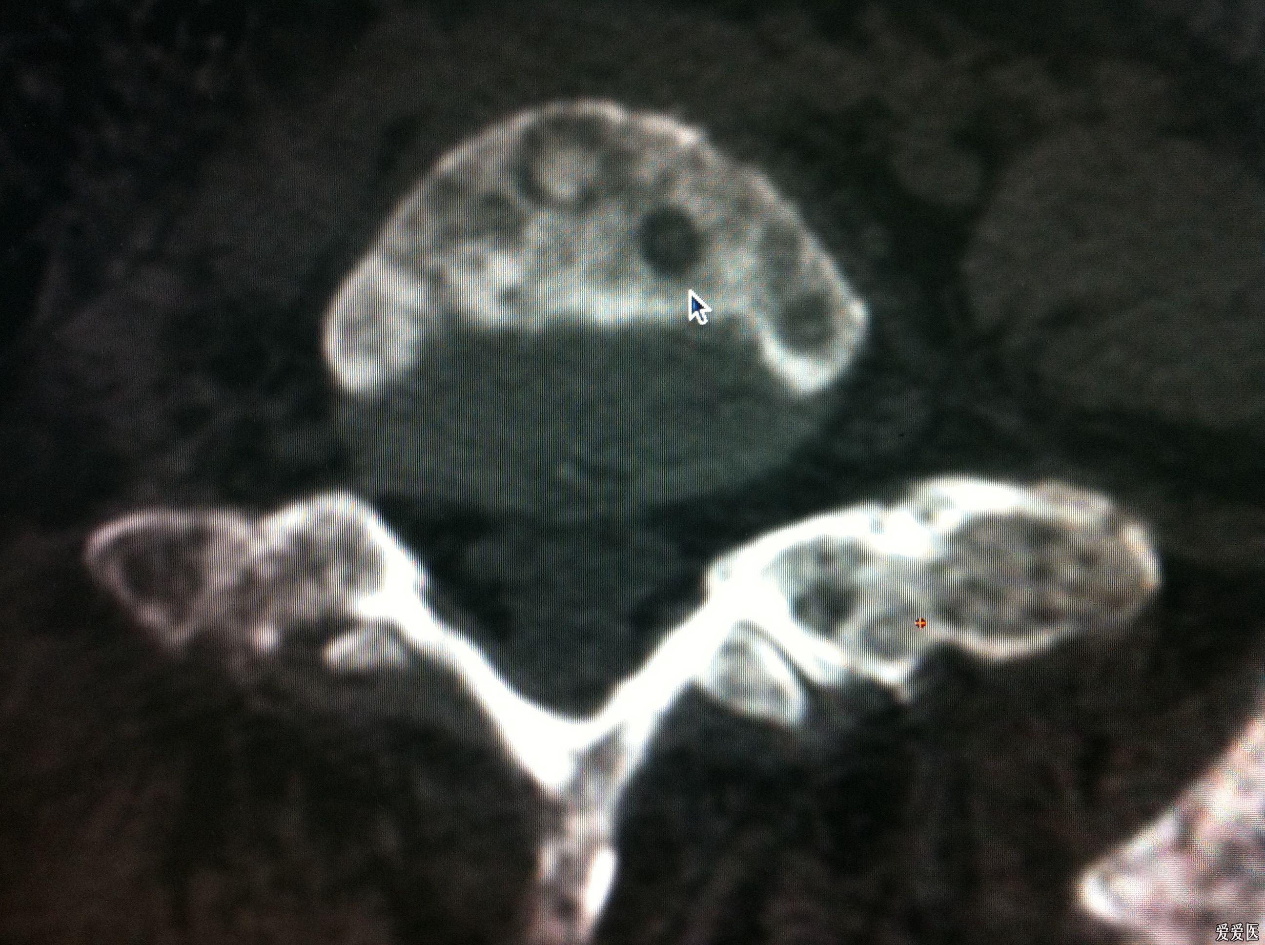 腰椎骨质破坏一例在线等各位大虾意见