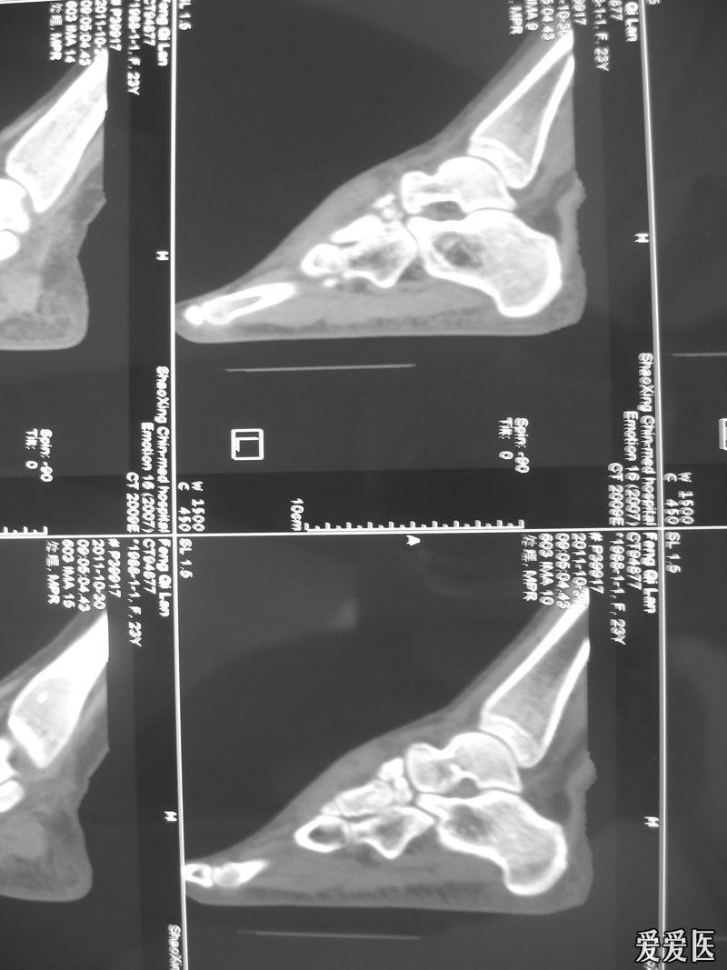 舟状骨ct图片