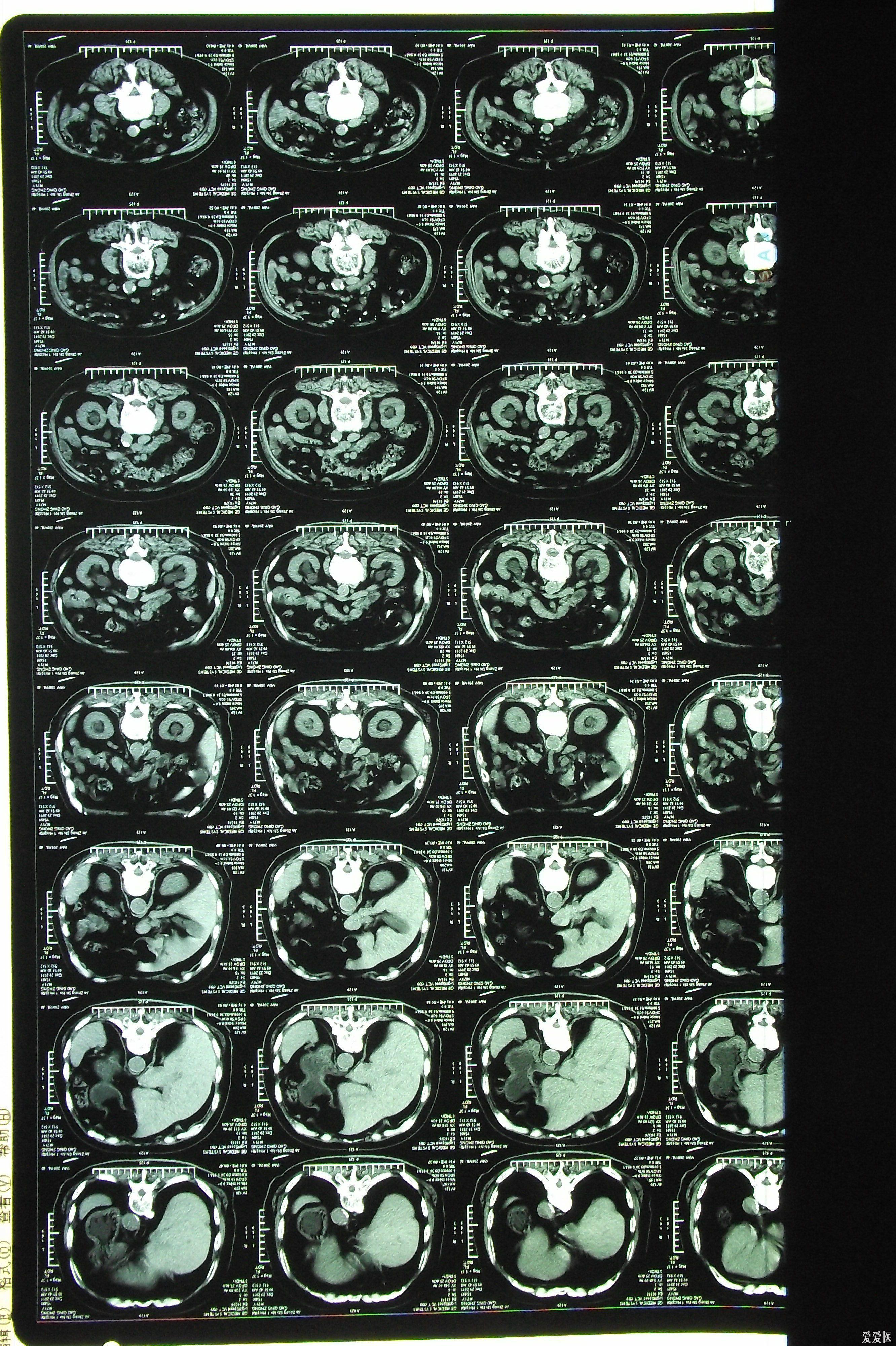膀胱癌术后复发
