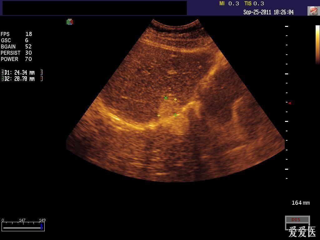 肝血管瘤超声表现图片图片