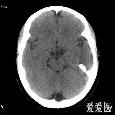 这下面的是那个脑池