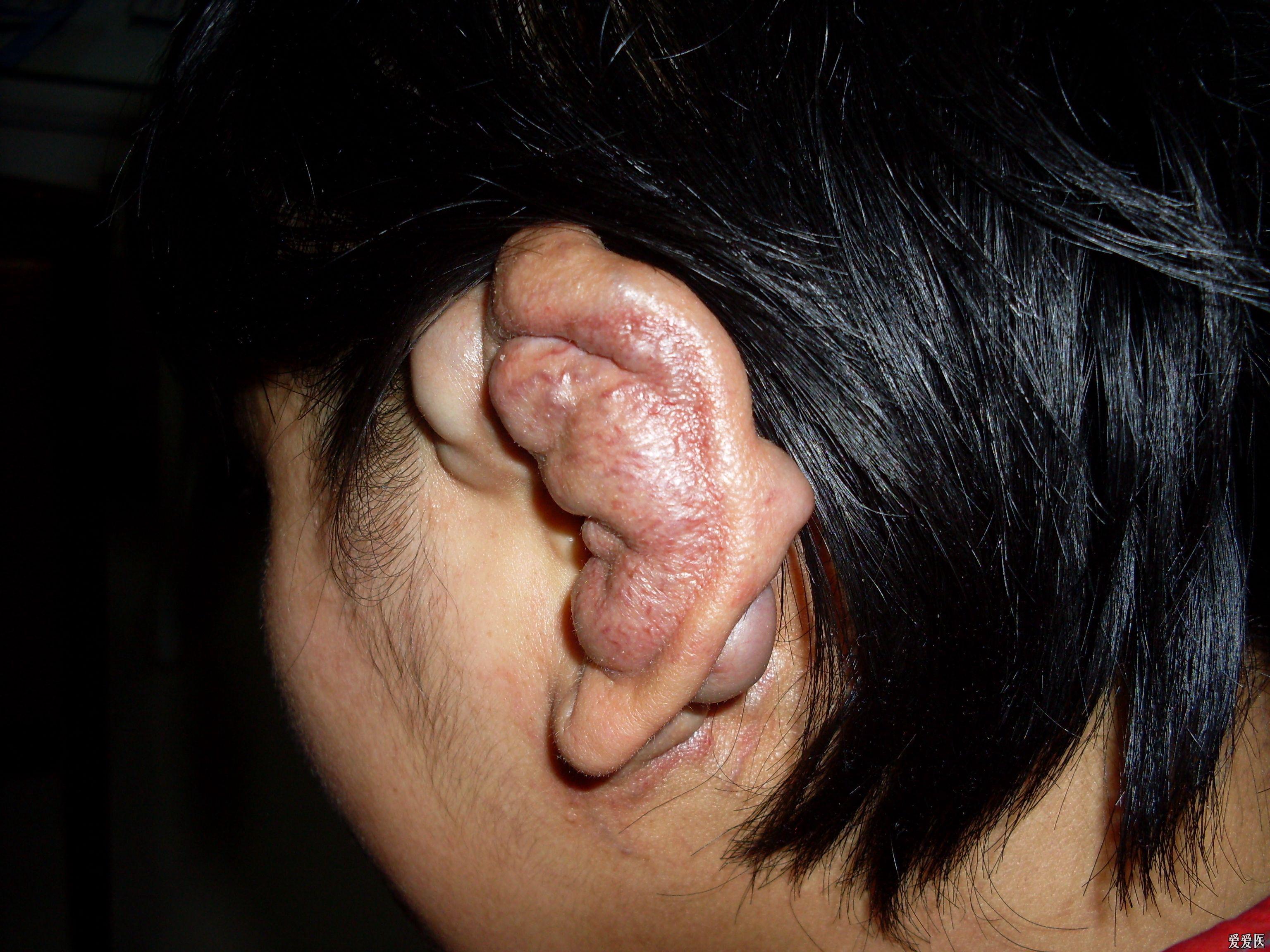 耳朵上的恶性肿瘤图片图片