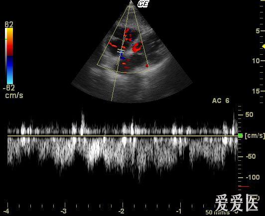 卵圆孔未闭