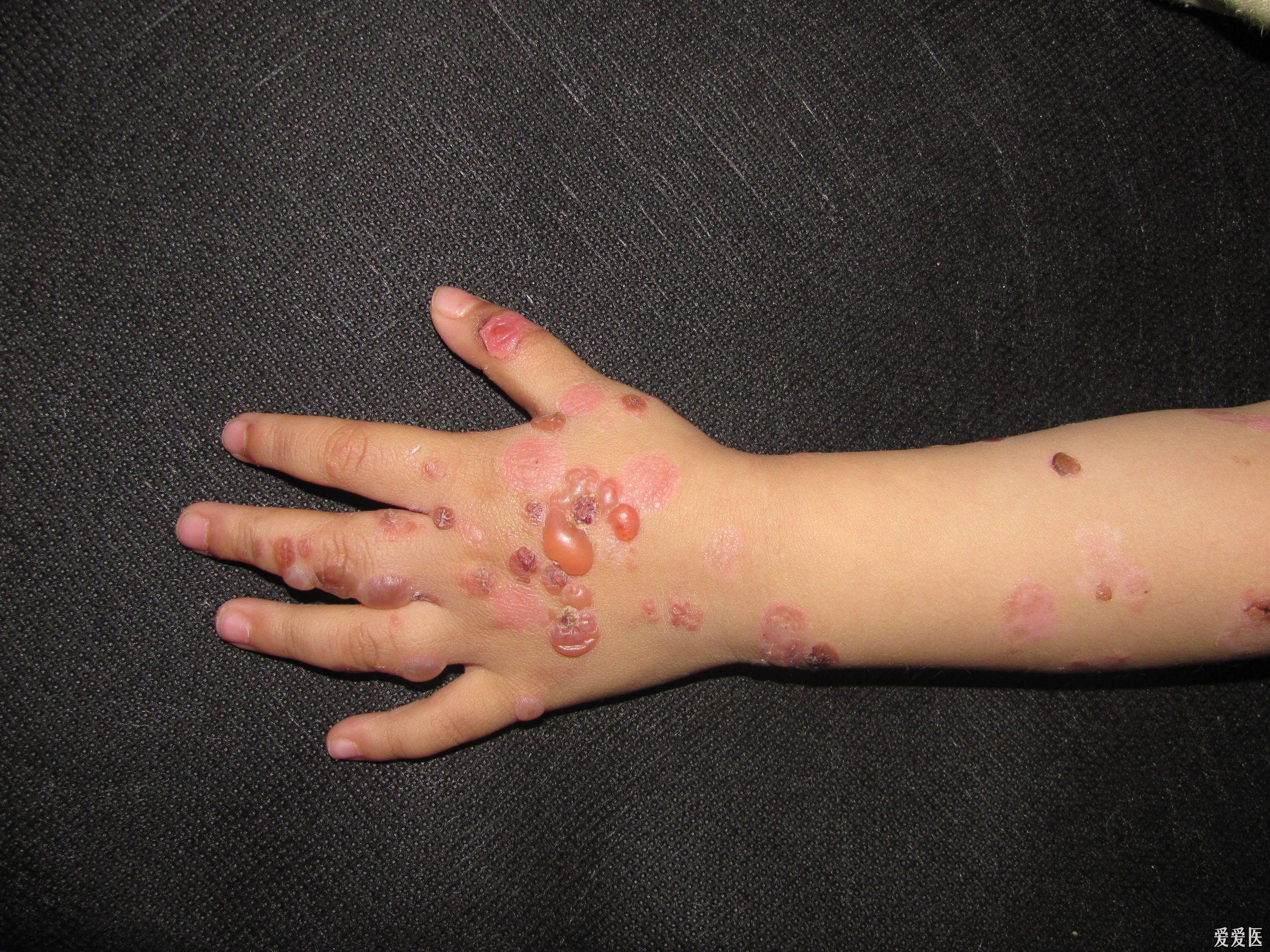 儿童大疱性皮肤病图片图片