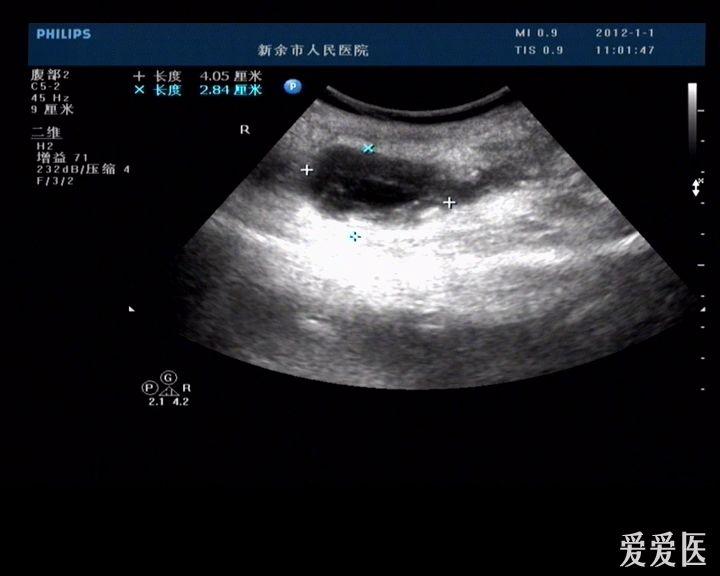 阑尾炎伴周围脓肿形成一例