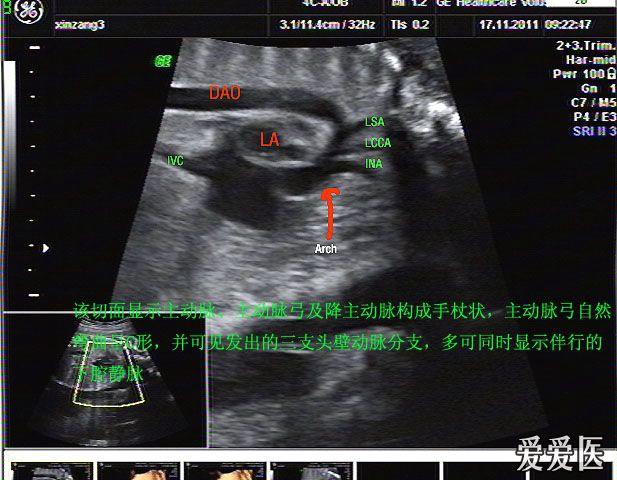 胎儿动脉导管切面图片图片